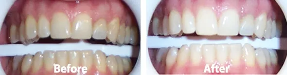 26658 laser teeth whitening austin procedure