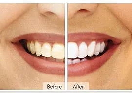 26665 teeth whitening provo image1