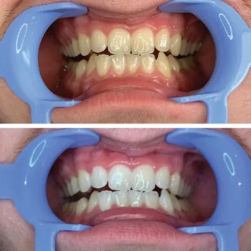 /img/26665-teeth-whitening-provo-image7.webp