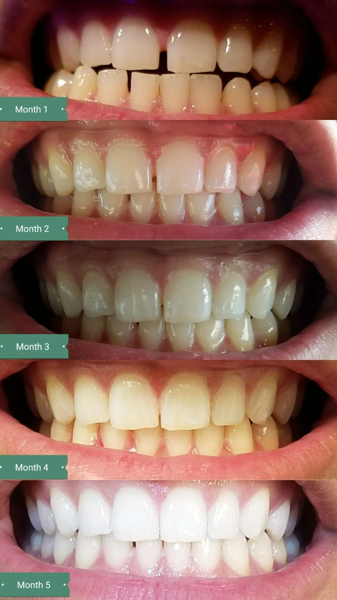 26666 smile direct whitening results
