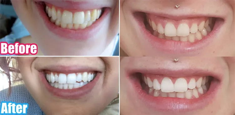 26668 whitening strips sore teeth 2