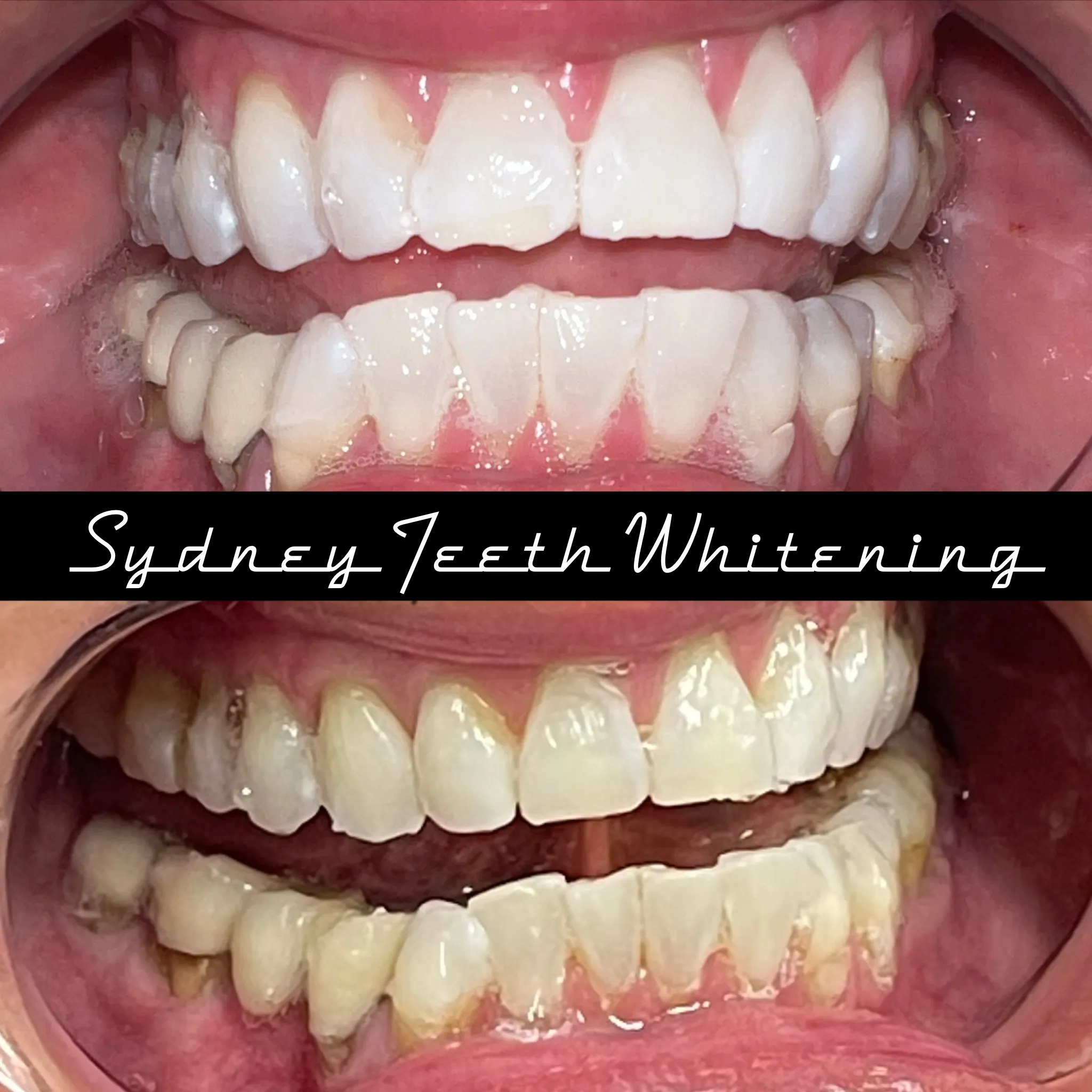 26670 teeth whitening process