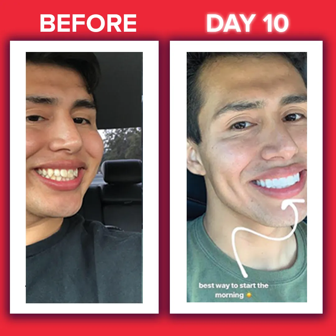 26687 applying zimba strips