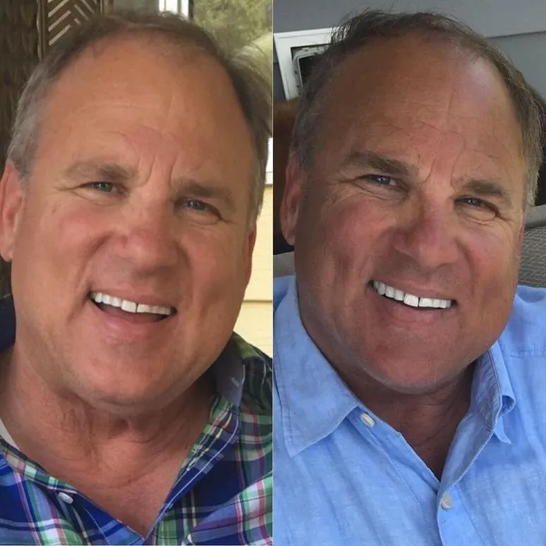 26695 teeth whitening comparison