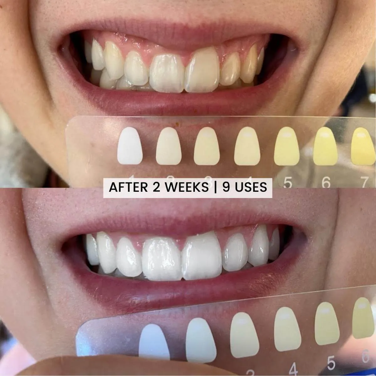 26695 teeth whitening process