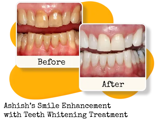 /img/26696-teeth-whitening-india-products.webp