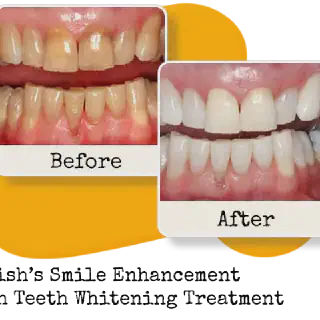 /img/26696-teeth-whitening-india-products.webp