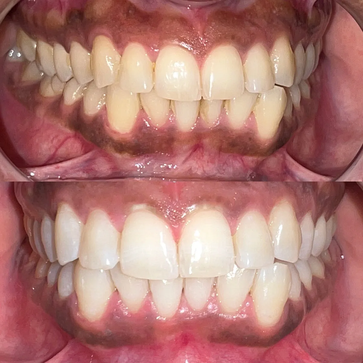 26696 types of teeth whitening