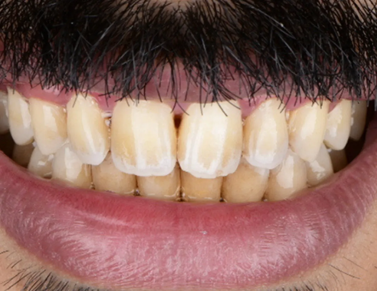 26697 zoom teeth whitening results