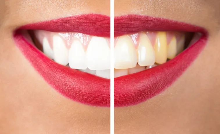 26698 in office teeth whitening