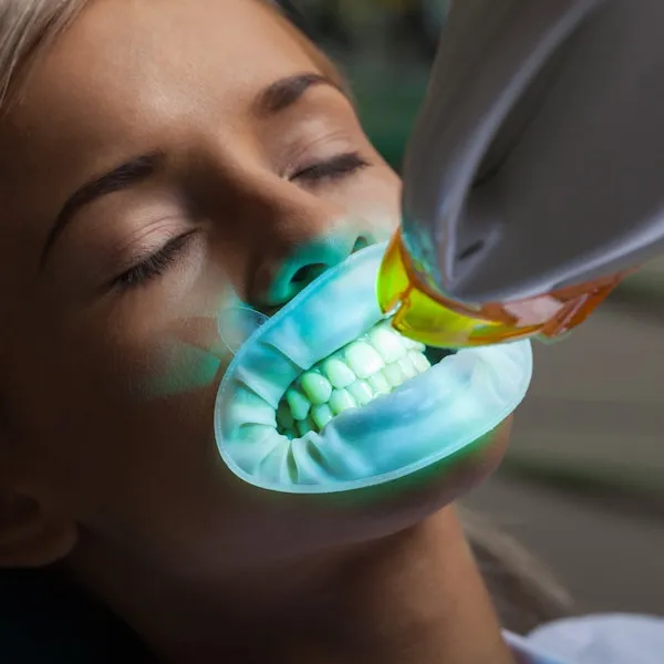 26698 take home whitening kits