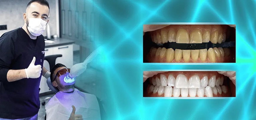 26698 teeth discoloration