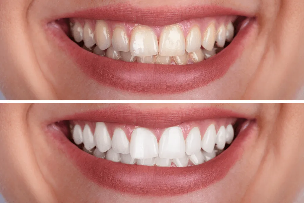 26698 teeth whitening oklahoma city 1