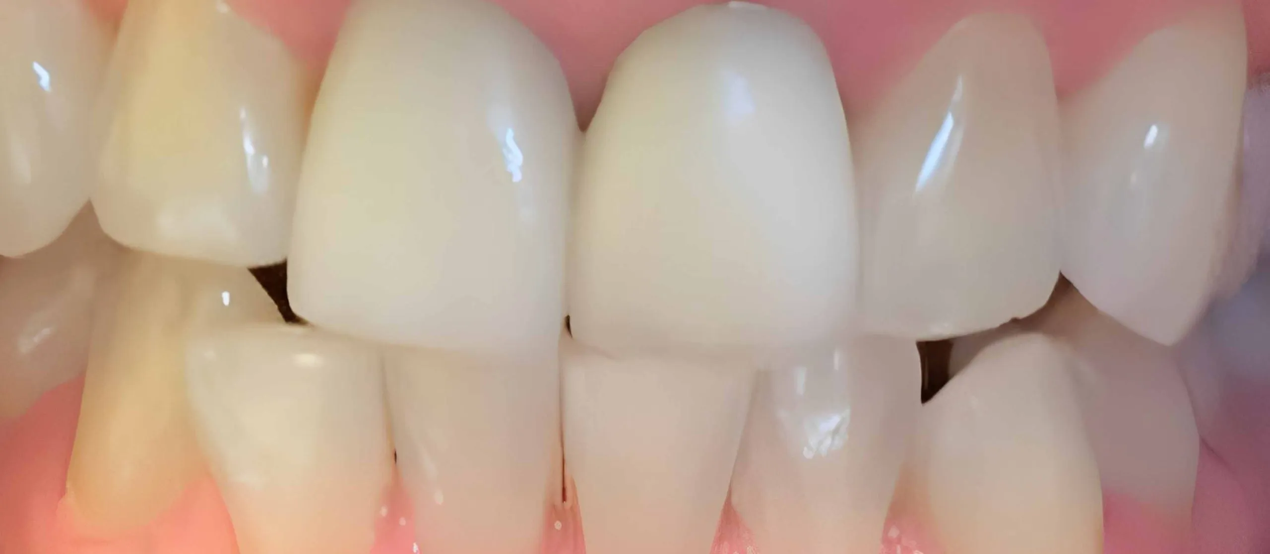 26702 teeth whitening overview