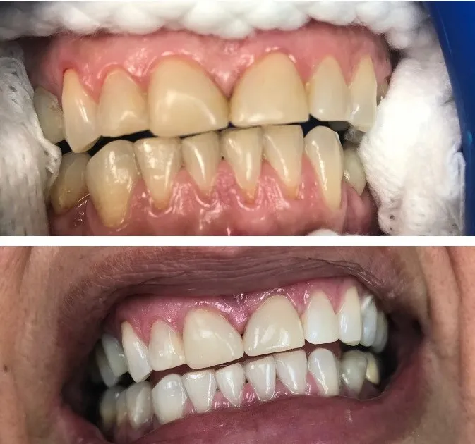 26712 teeth whitening haywards heath 1