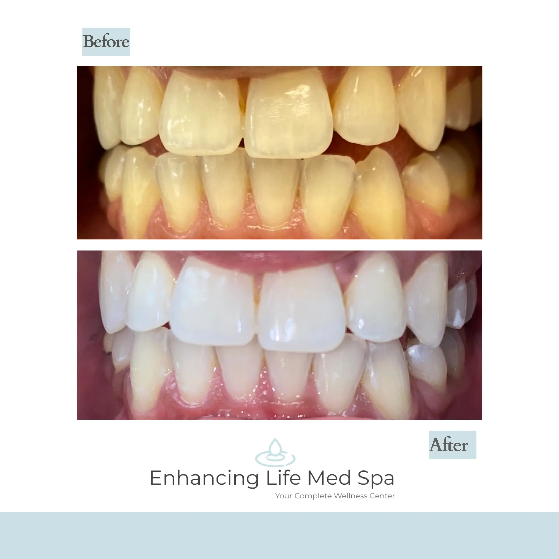 26712 teeth whitening haywards heath 5