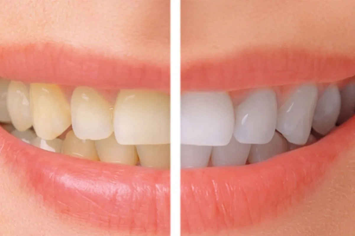 26712 teeth whitening haywards heath 6