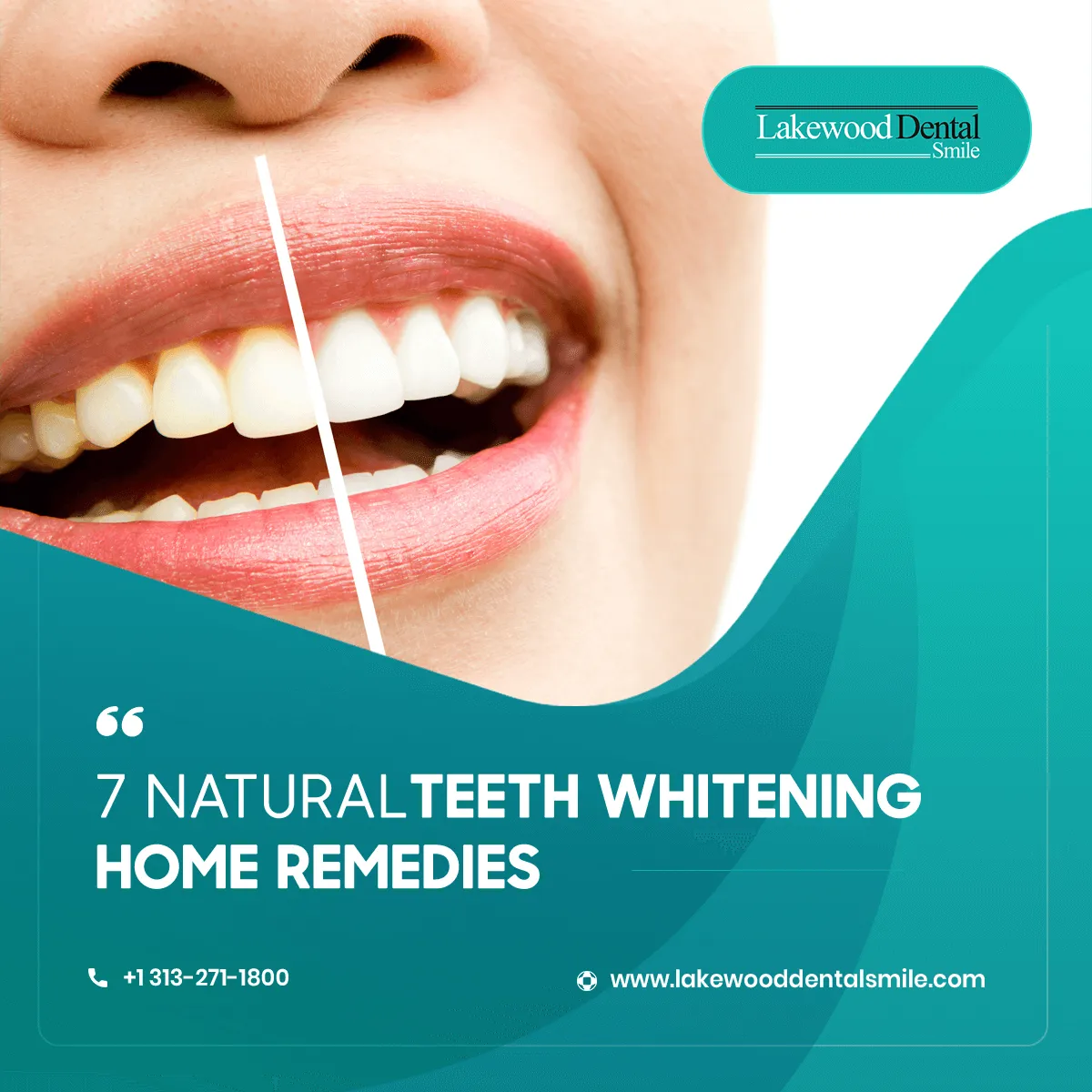 26724 diy teeth whitening