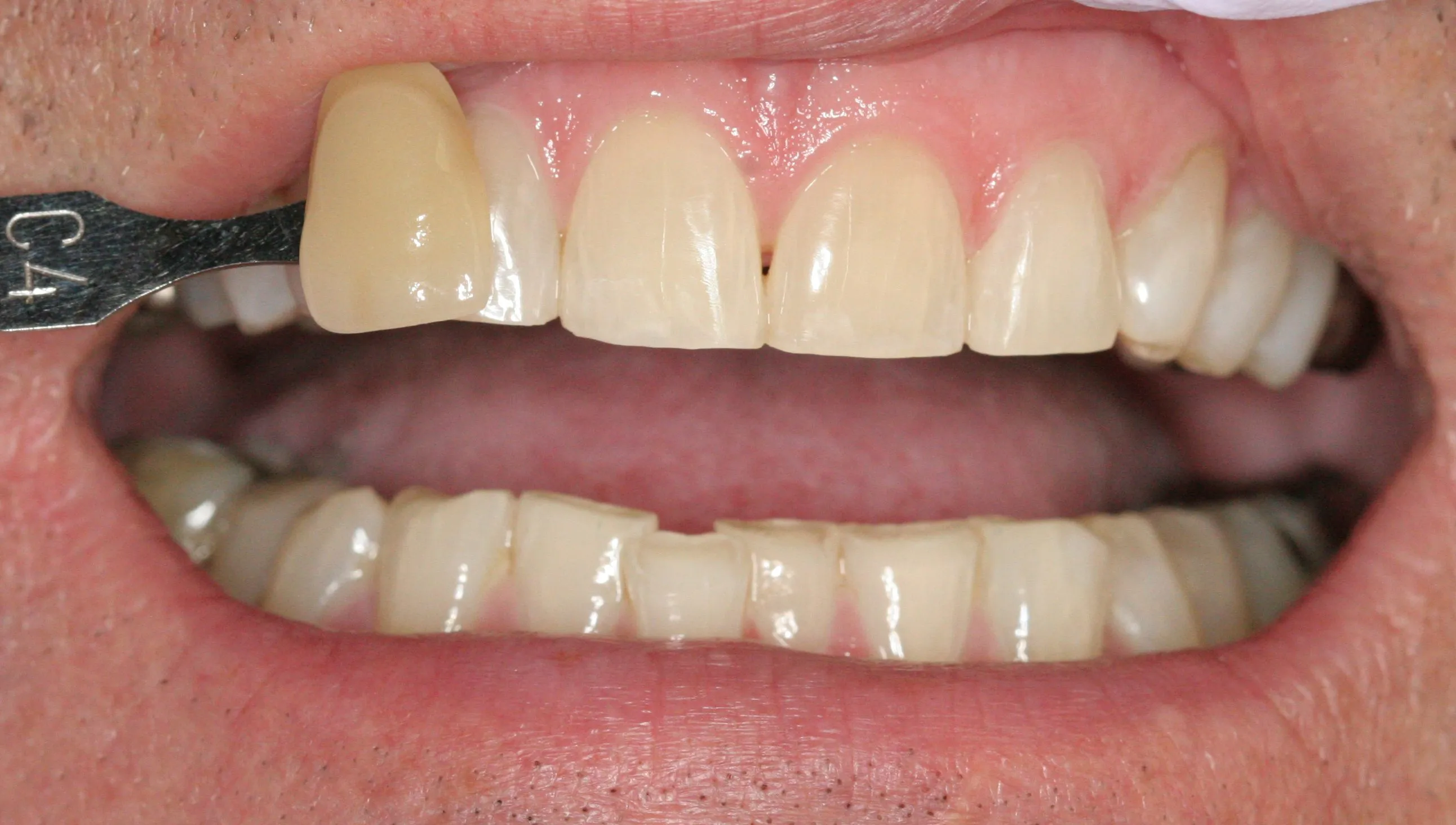 26725 at home whitening kits