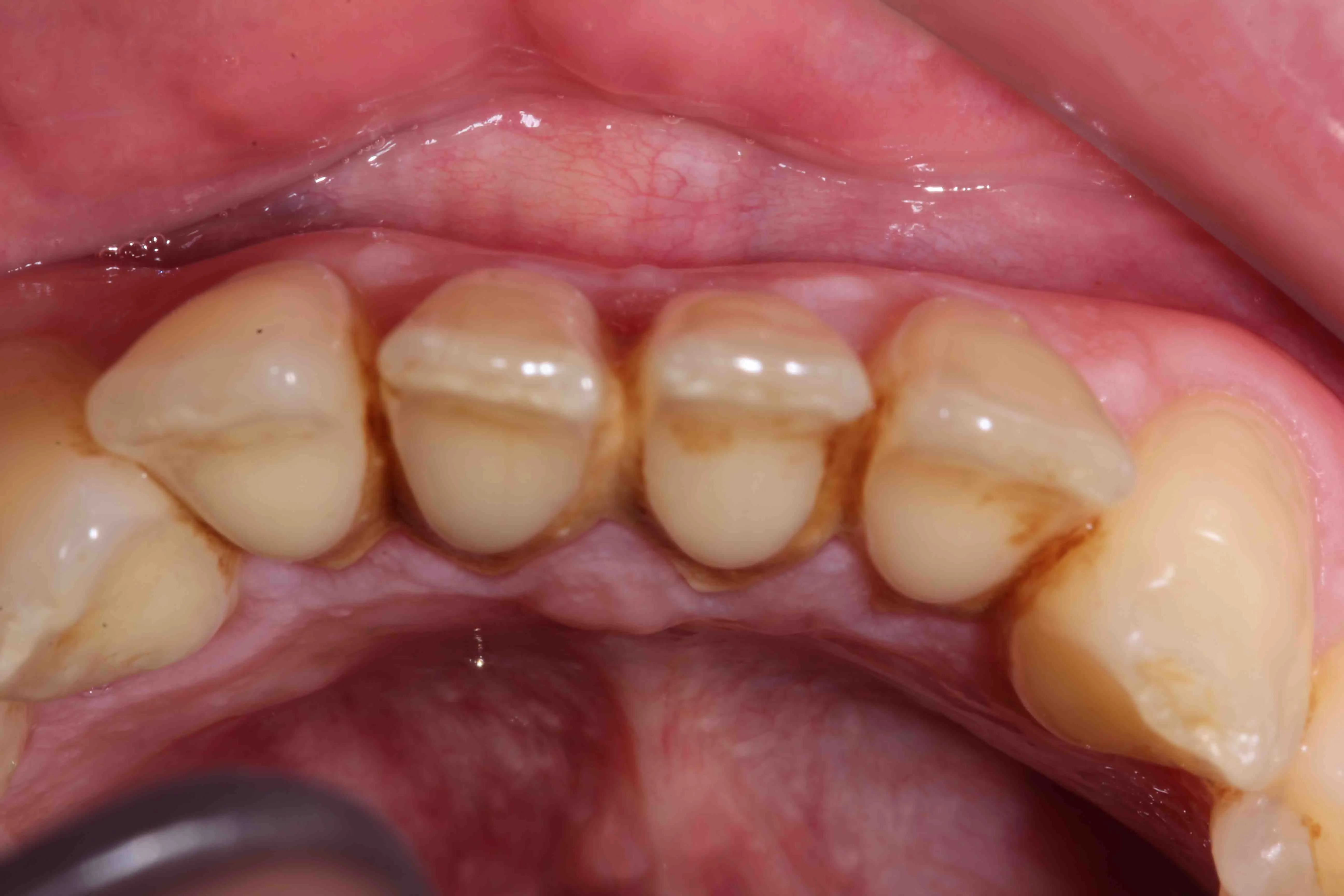 26725 professional whitening