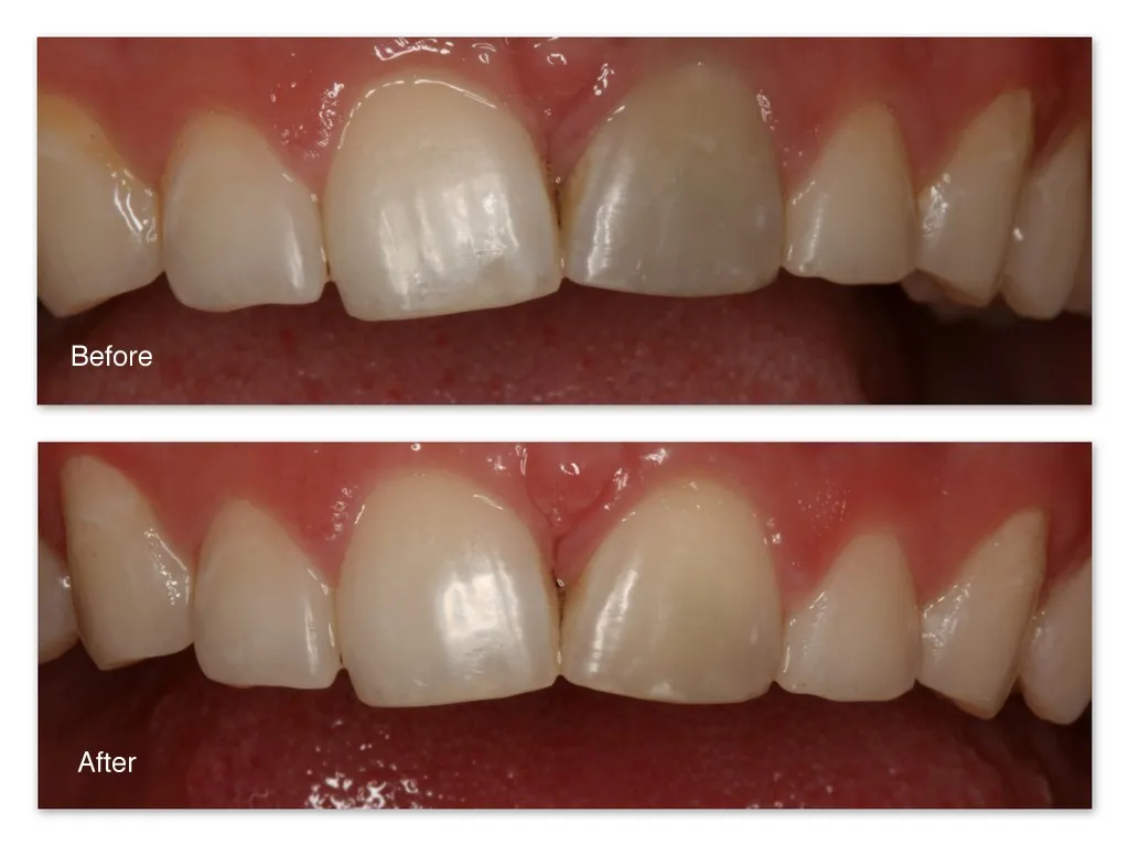 26725 tooth discoloration causes