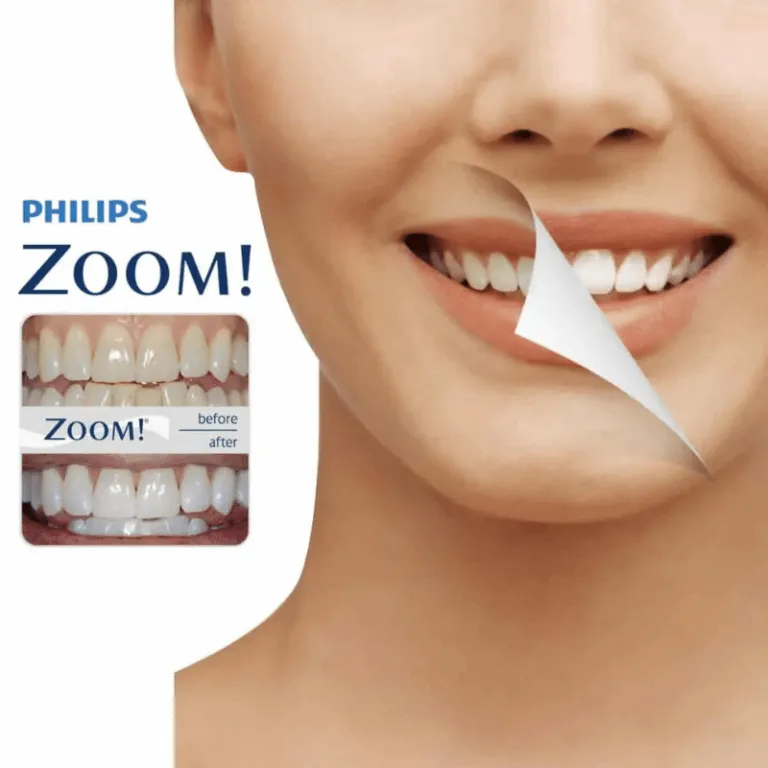 26730 philips zoom gel before after