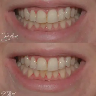 /img/26737-baking-soda-teeth-whitening-guide.webp