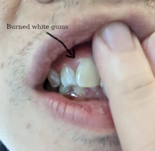 26744 teeth whitening burned gums 1