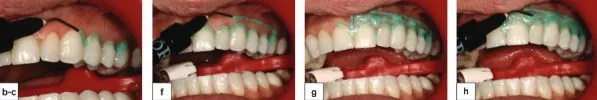 26744 teeth whitening burned gums 2