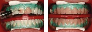26744 teeth whitening burned gums 3