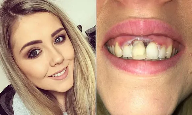 26744 teeth whitening burned gums 4