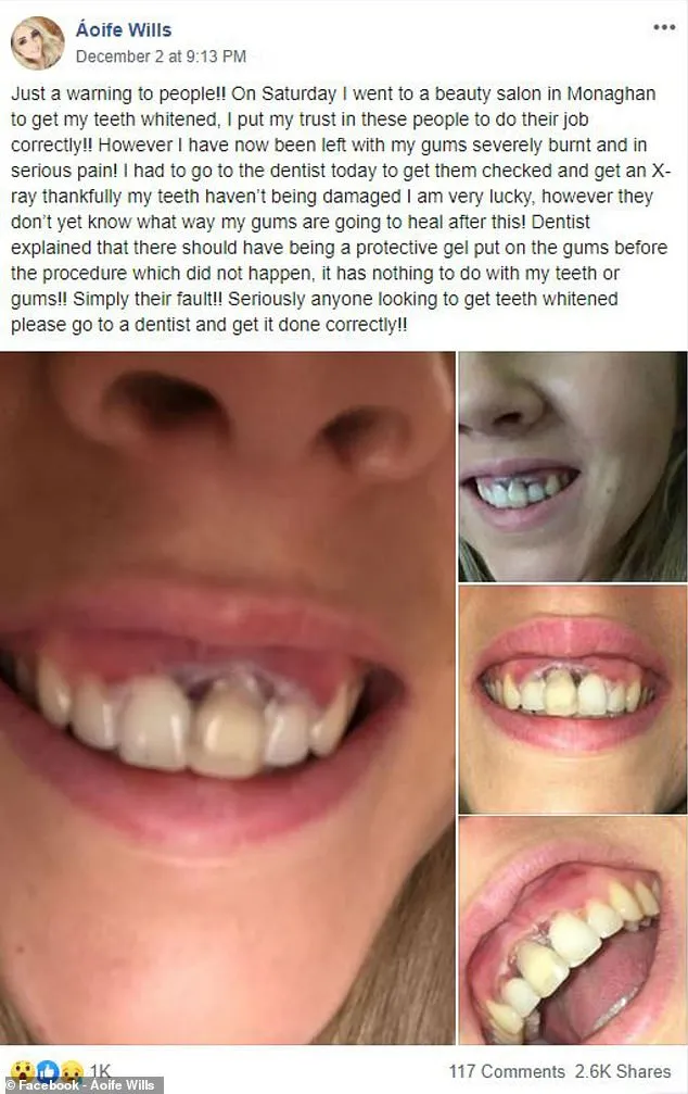 26744 teeth whitening burned gums 5