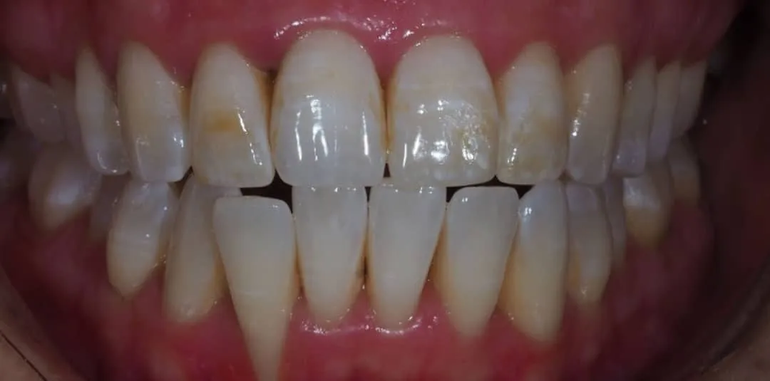 26744 teeth whitening burned gums 6
