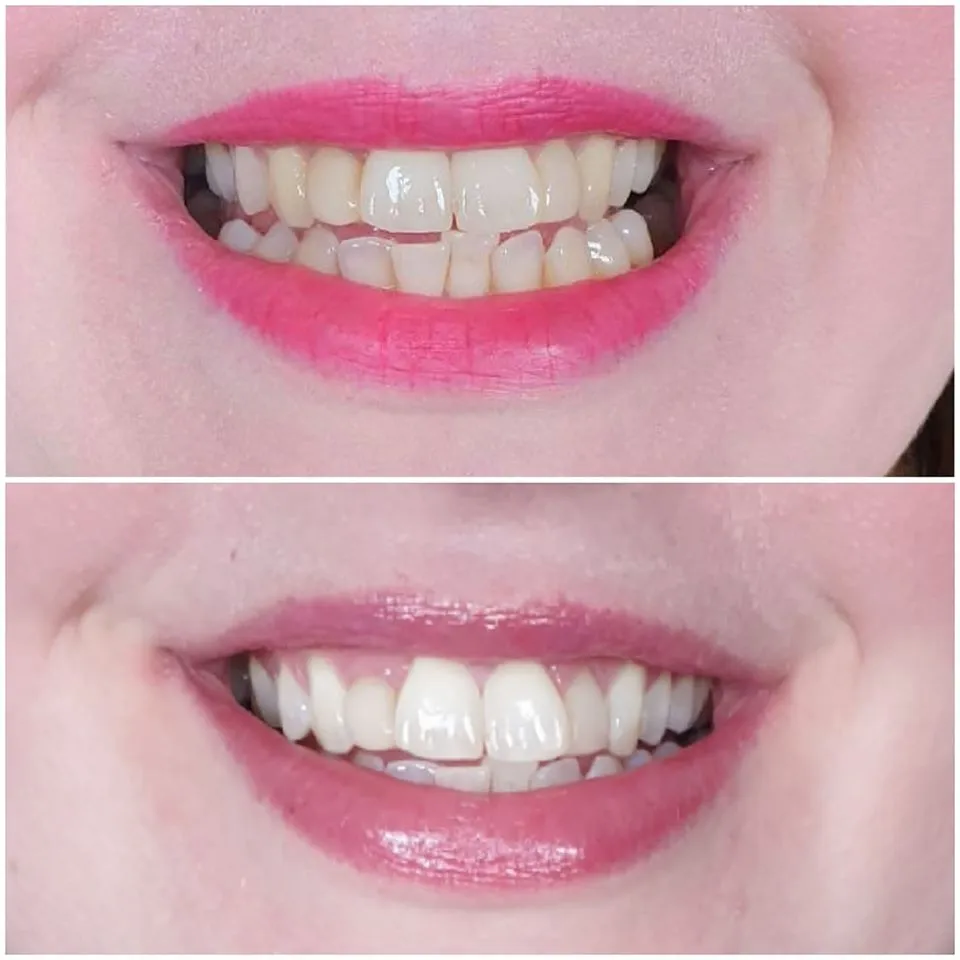 26745 laser teeth whitening york clinic