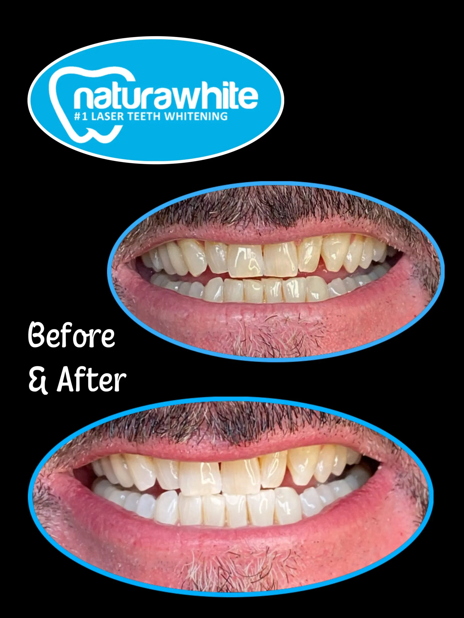 26745 teeth whitening smile