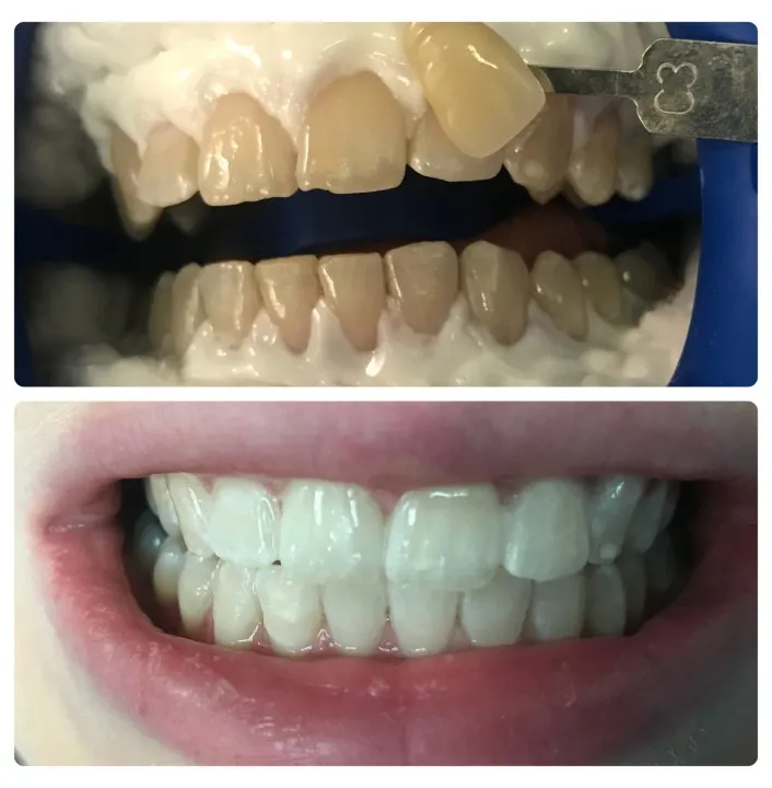 26747 teeth whitening process