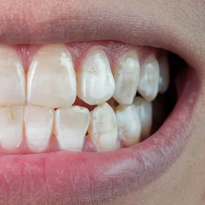 26751 teeth whitening redlands at home kits