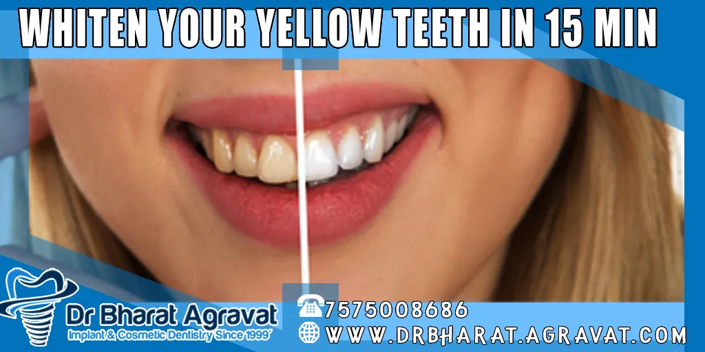 26752 laser technology teeth whitening