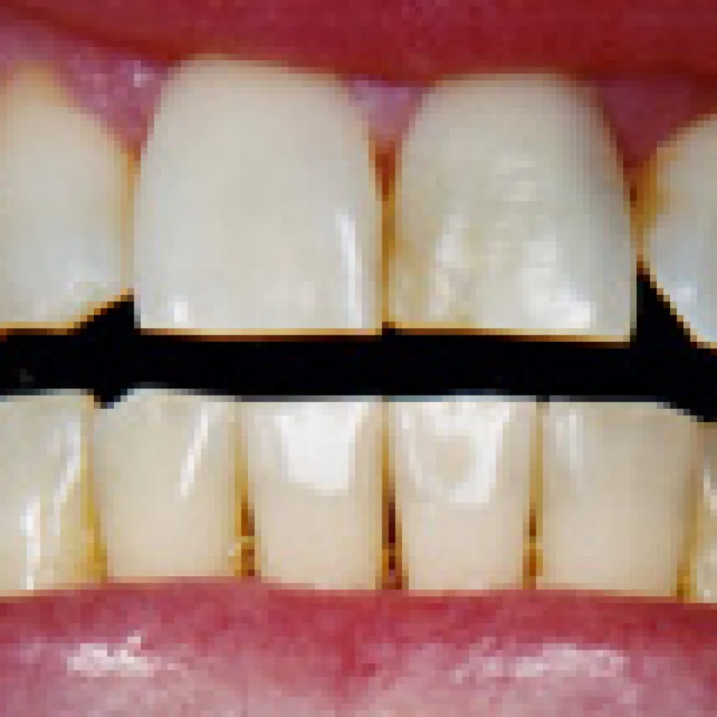 26755 sensitive teeth explained