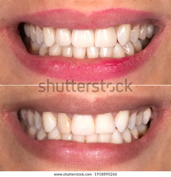 26755 whitening products mechanism