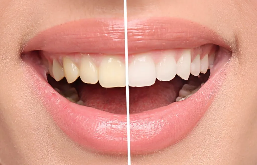 26756 teeth whitening comparison