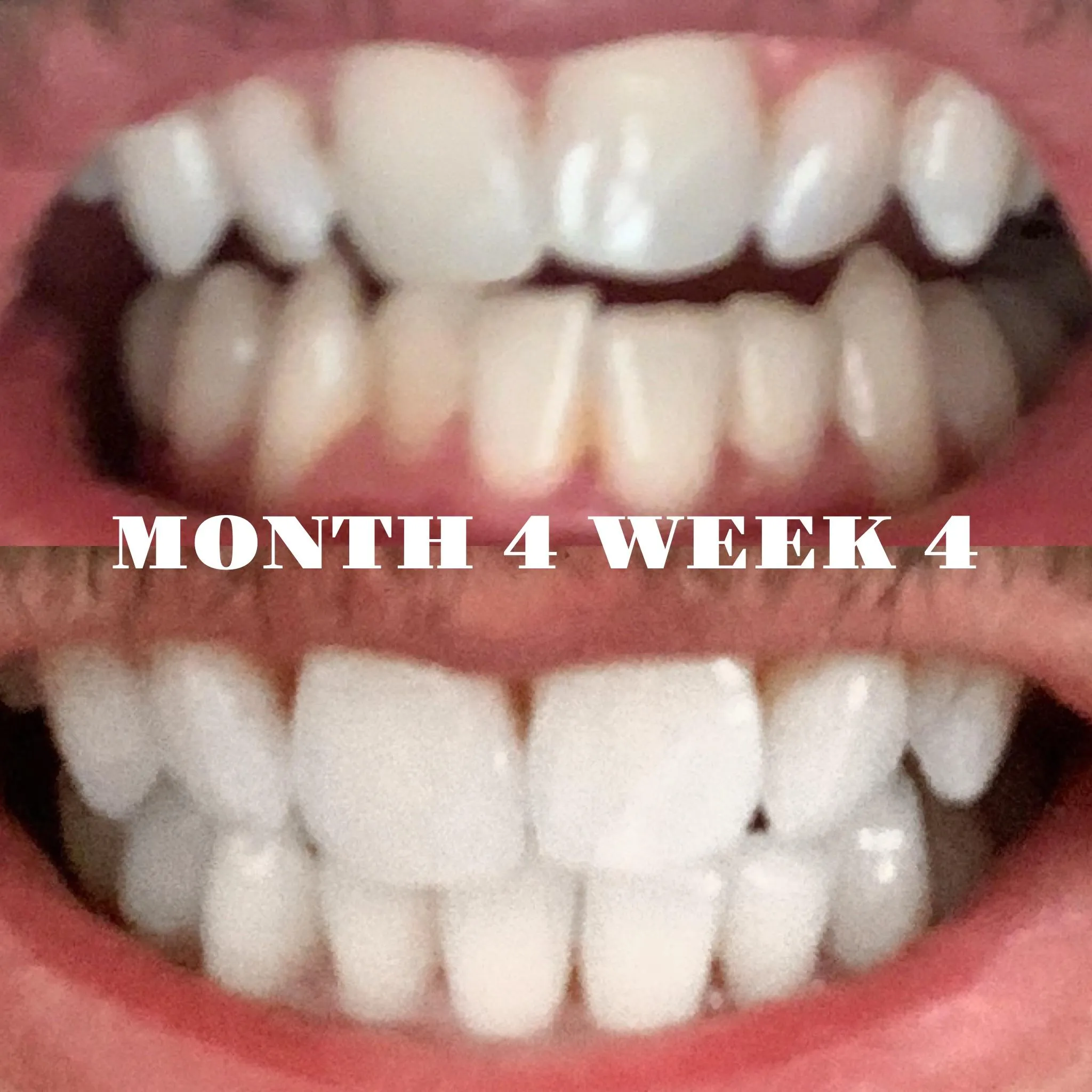 26757 smile whitening results