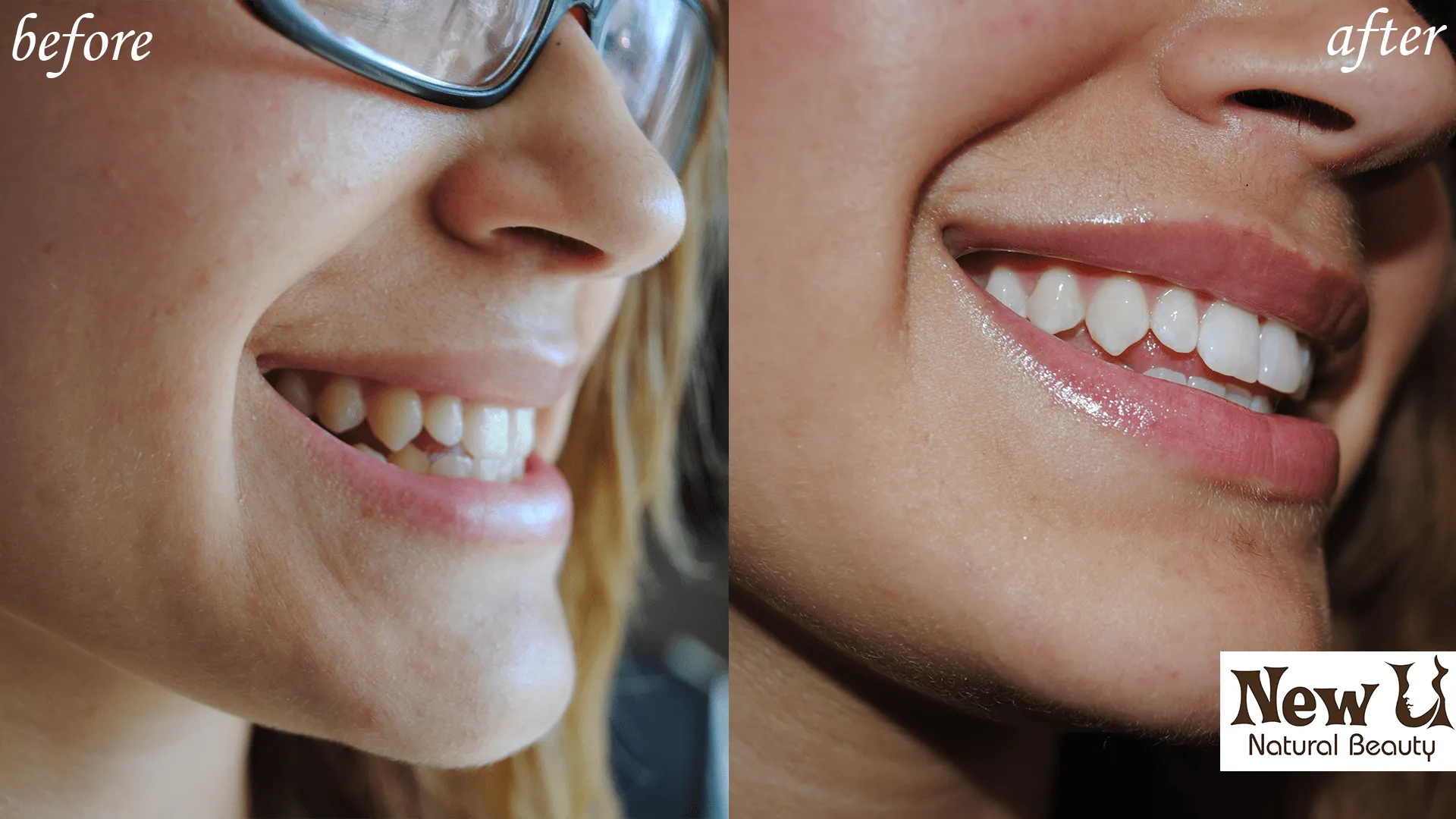 26758 teeth whitening las vegas image 2