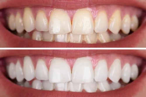 26758 teeth whitening las vegas image 5