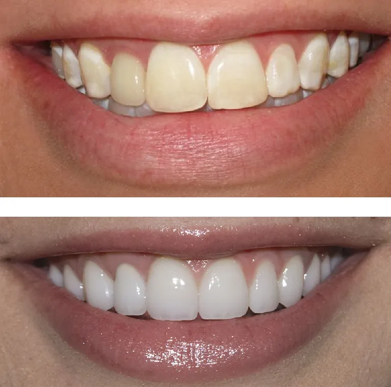 26761 at home teeth whitening products