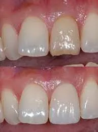 26761 common causes uneven whitening