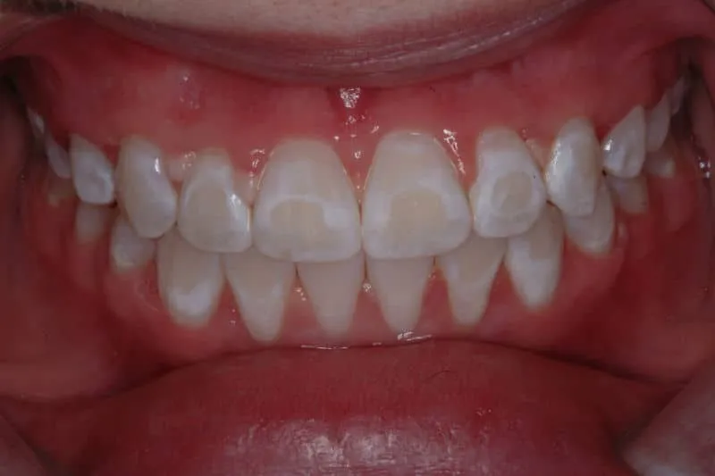 26761 teeth whitening process