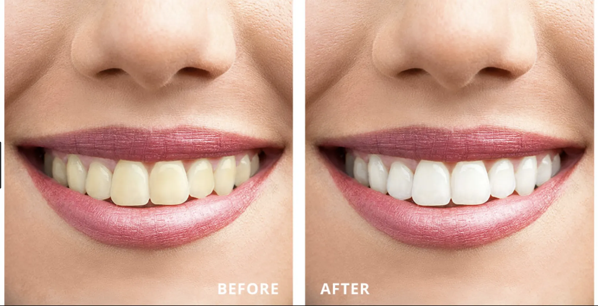 /img/26772-teeth-whitening-salisbury-smile.webp