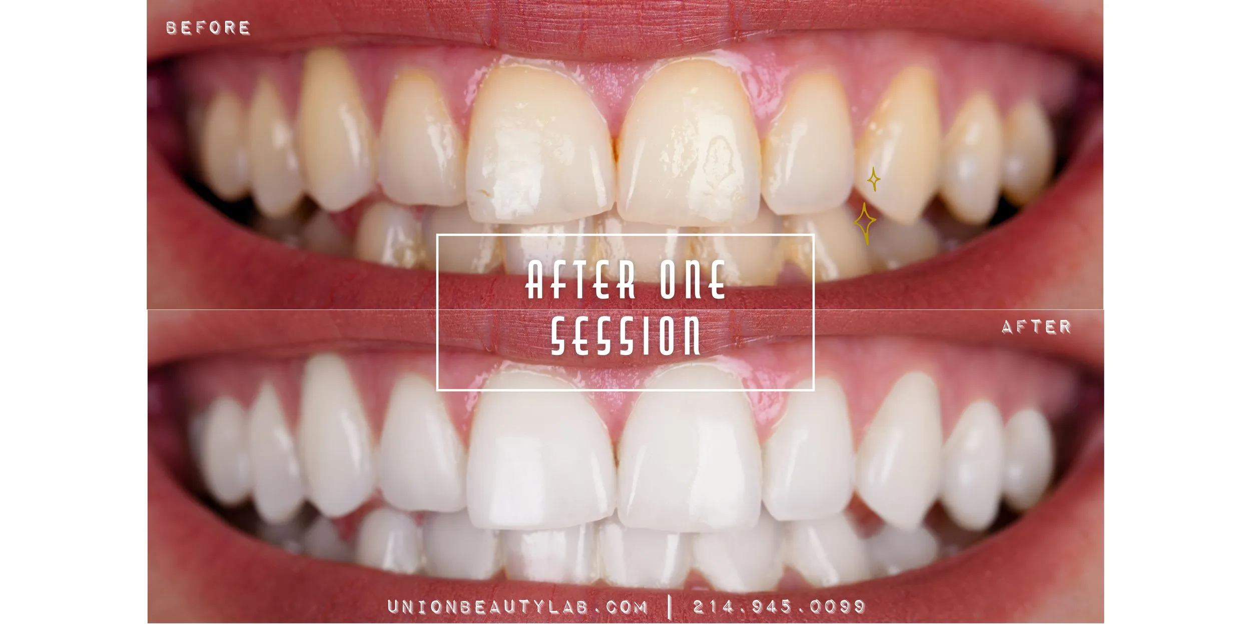 26775 teeth whitening benefits