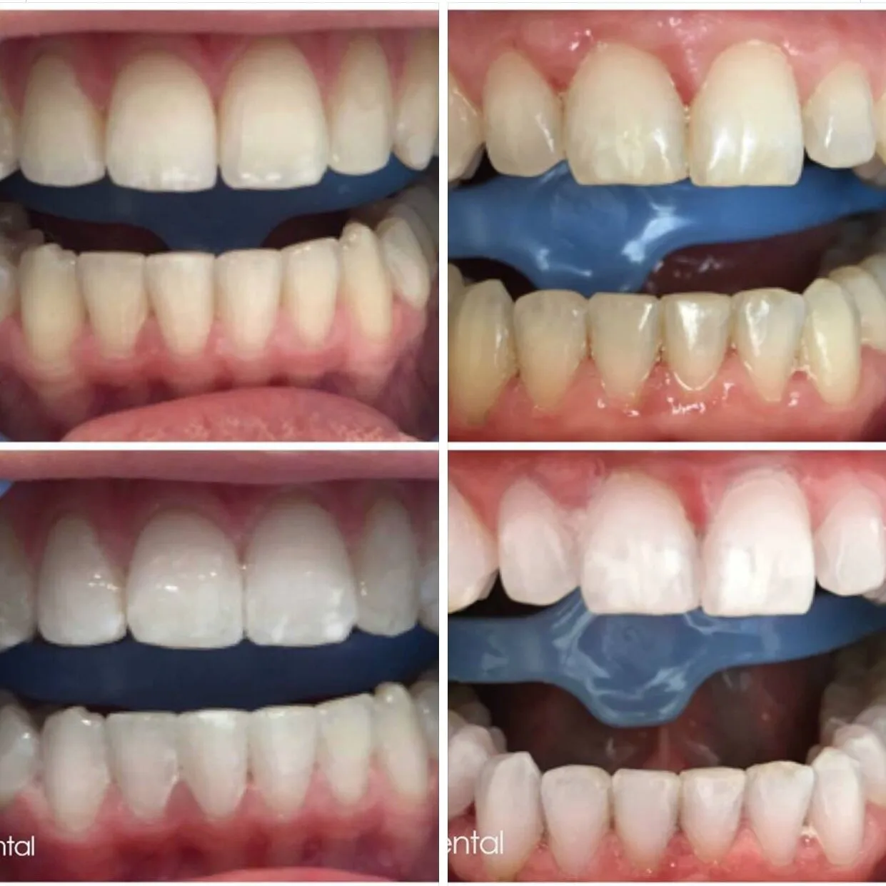 26782 maintaining whitened smile